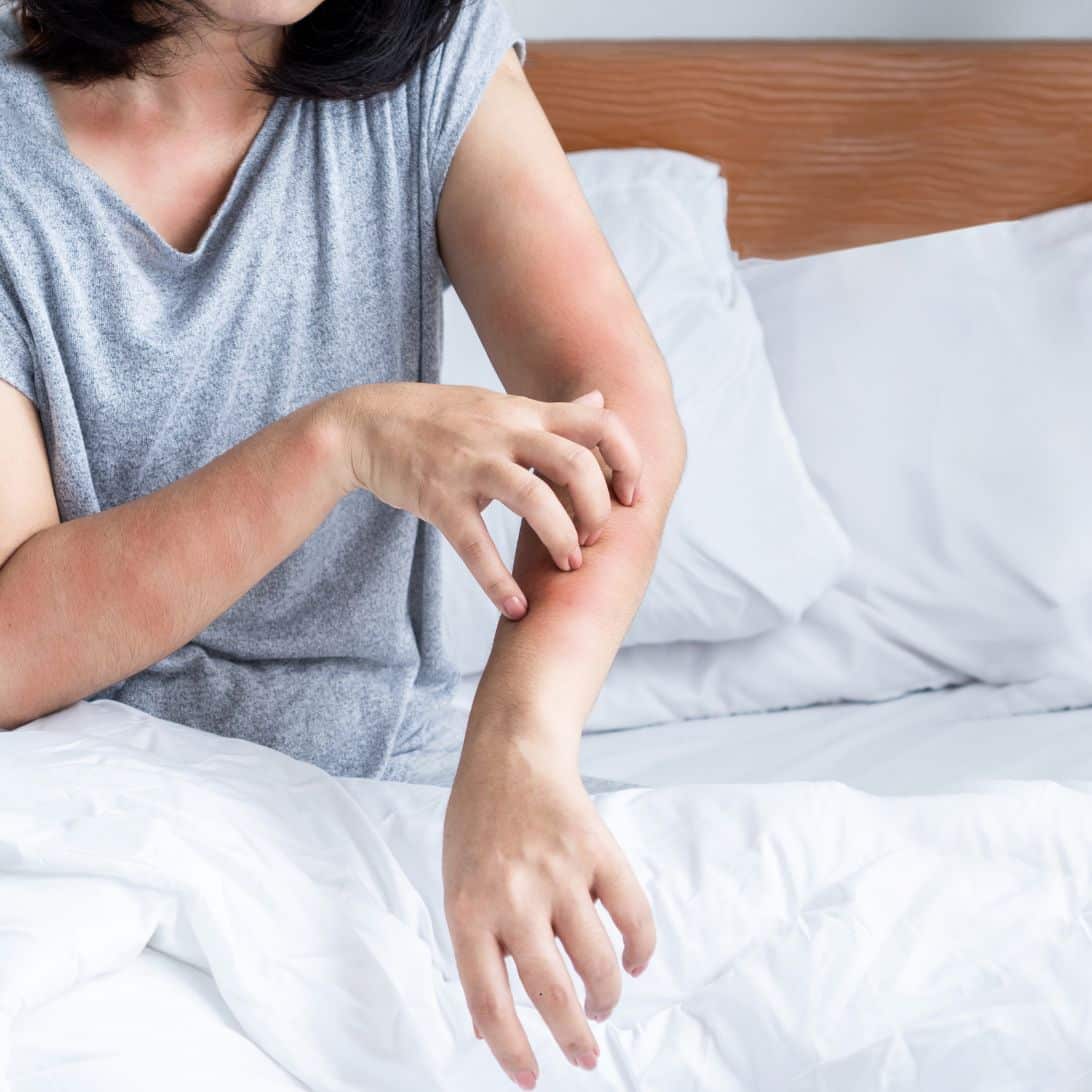 vrouw die jeuk heeft door Bedwantsen